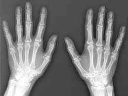 X-ray image of two Hands