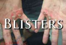 Blisters Are Preventable, But Learn How To Identify & Treat Them Just In Case – First Aid External First Aid Training - Blisters