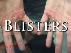 External First Aid Training - Blisters