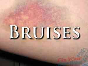External First Aid Training - Bruises