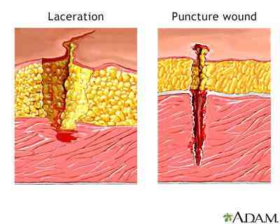 Lacerations versus puncture wounds first aid