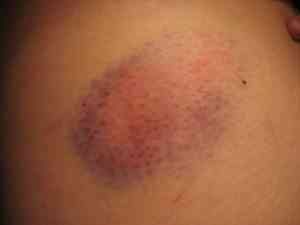 Light Bruising