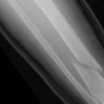 Oblique Displaced Arm Fracture