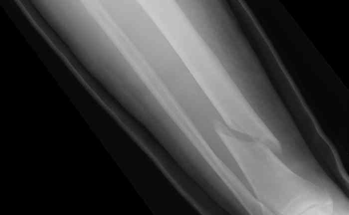 Oblique Displaced Arm Fracture X-Ray
