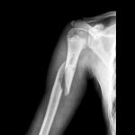 Arm Spiral Fracture