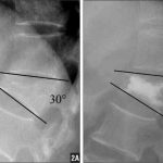 Spinal Compression Fracture